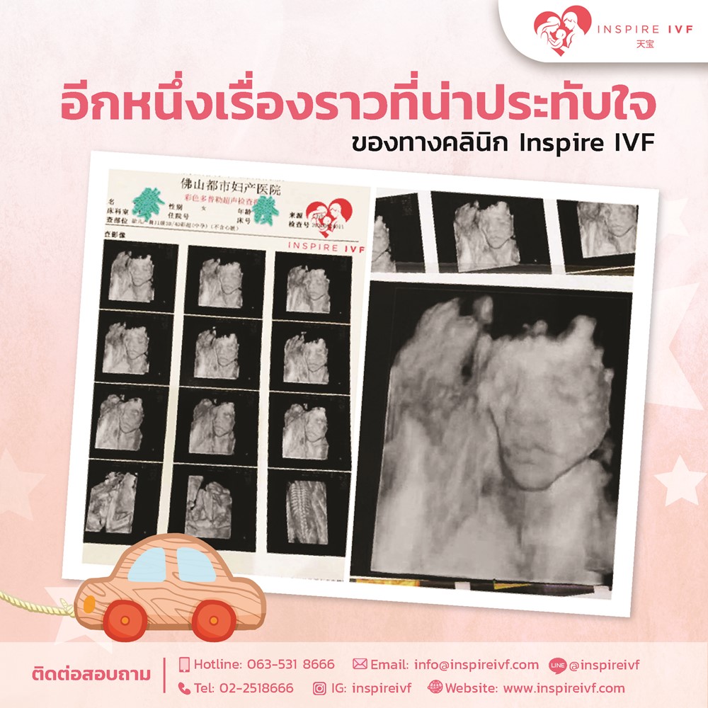 ขอบคุณภาพ Ultrasound 4D จากคุณ Zhang ส่งมาจากประเทศจีน เพื่อให้ทางคลินิก Inspire IVF ได้ชื่นชม